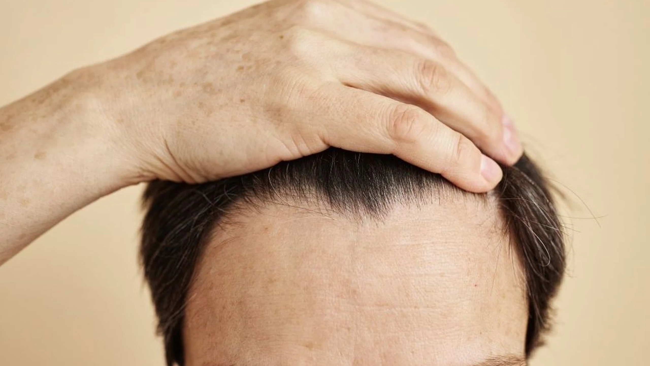 Trán hói: Nguyên nhân, dấu hiệu và giải pháp chăm sóc