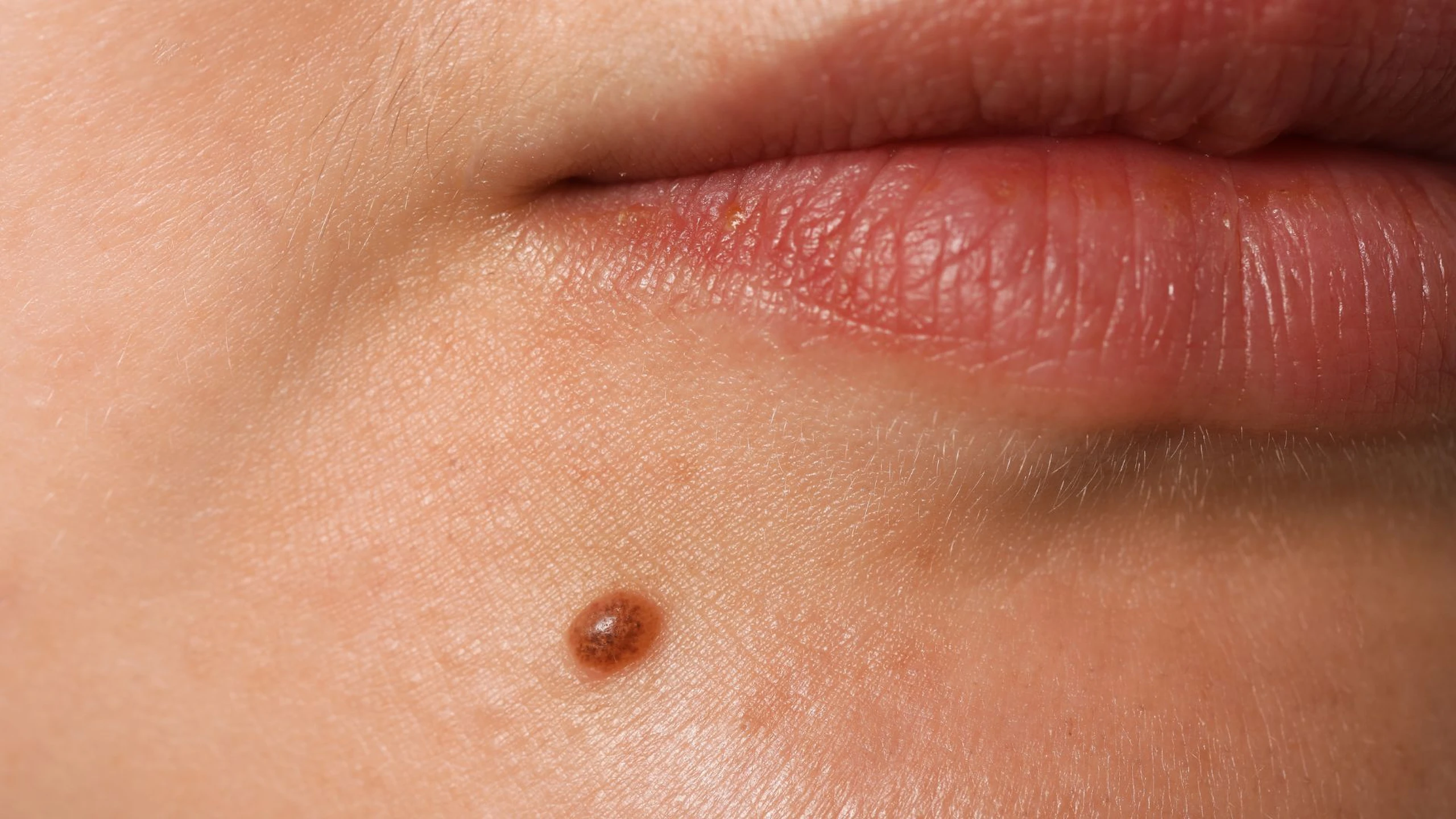 Tự nhiên mọc nốt ruồi có sao không? Sự hình thành nốt ruồi mới như thế nào?