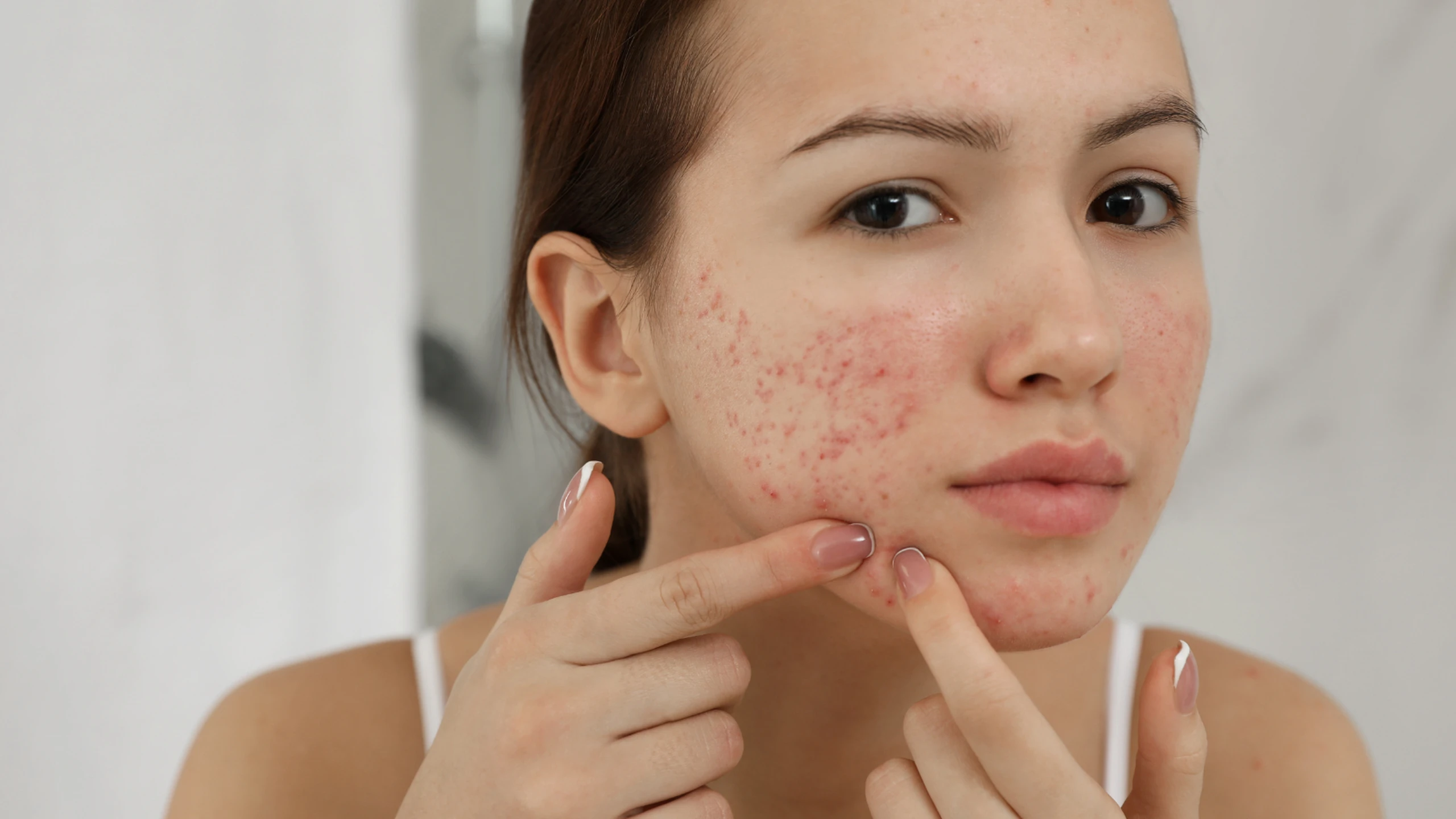 Uống viên cấp nước bị nổi mụn: Nguyên nhân và cách xử trí