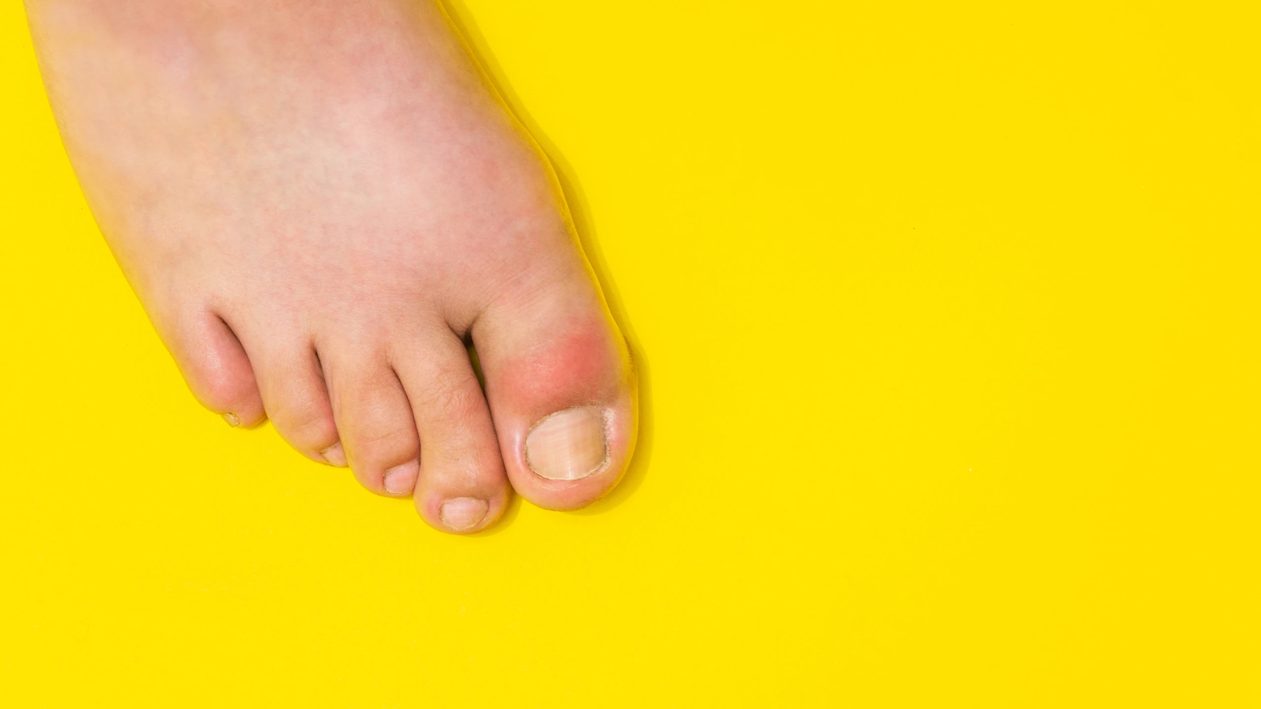 Vì sao bệnh gout dễ bùng phát vào dịp Tết?