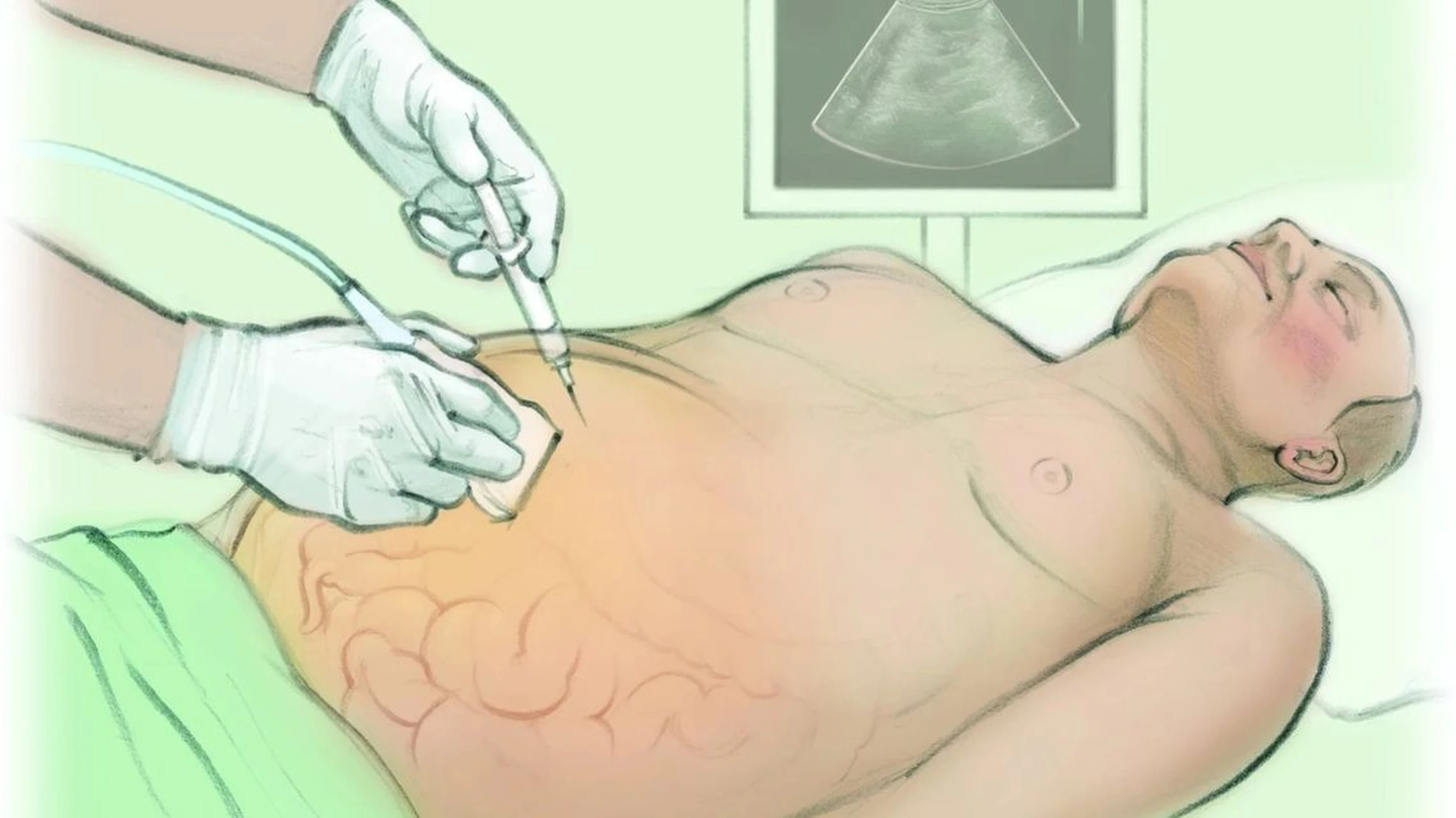 Vị trí chọc dịch ổ bụng ở đâu? Quy trình và những điều cần lưu ý