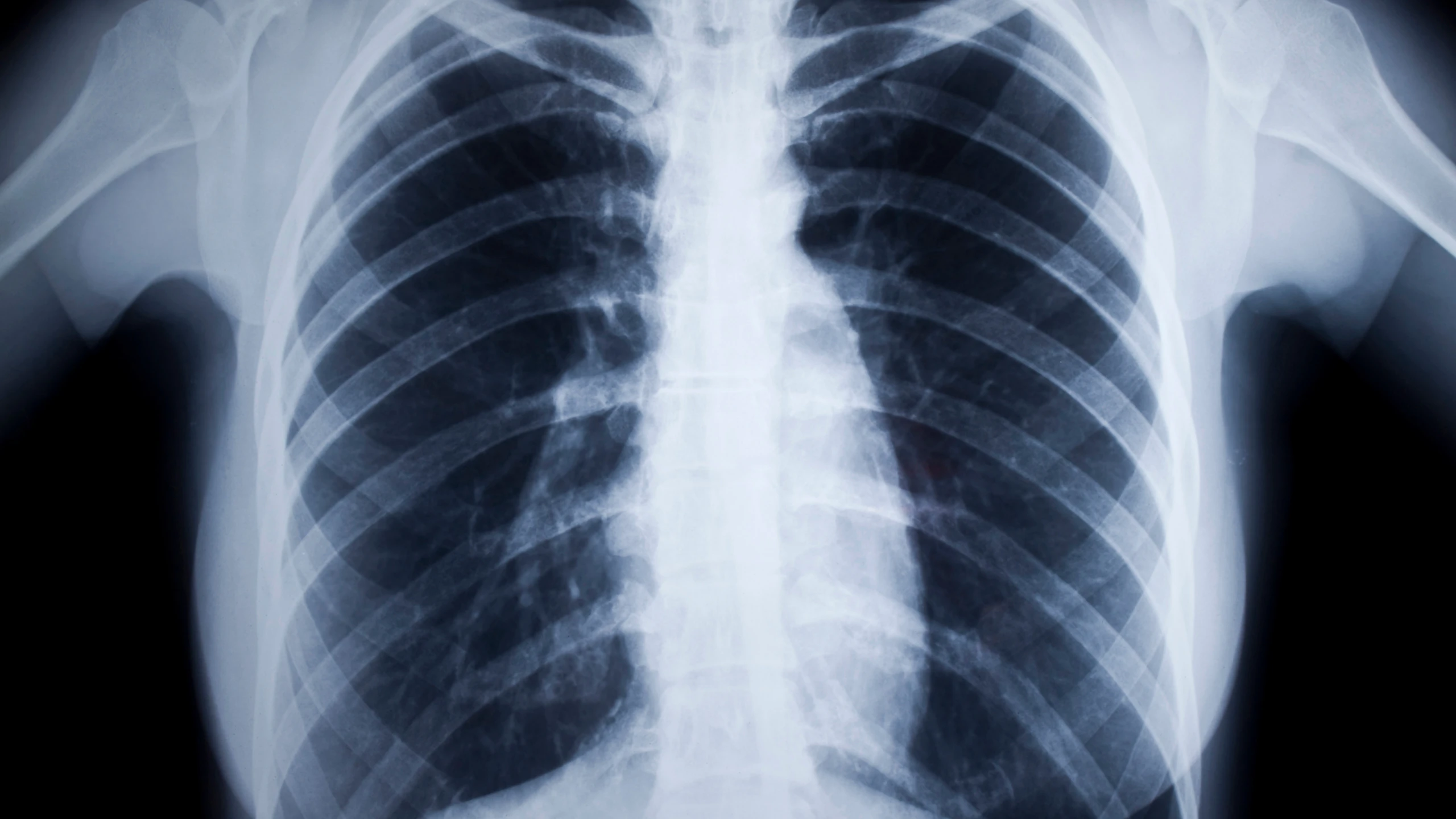 X-quang giãn phế quản và vai trò trong đánh giá bệnh hô hấp