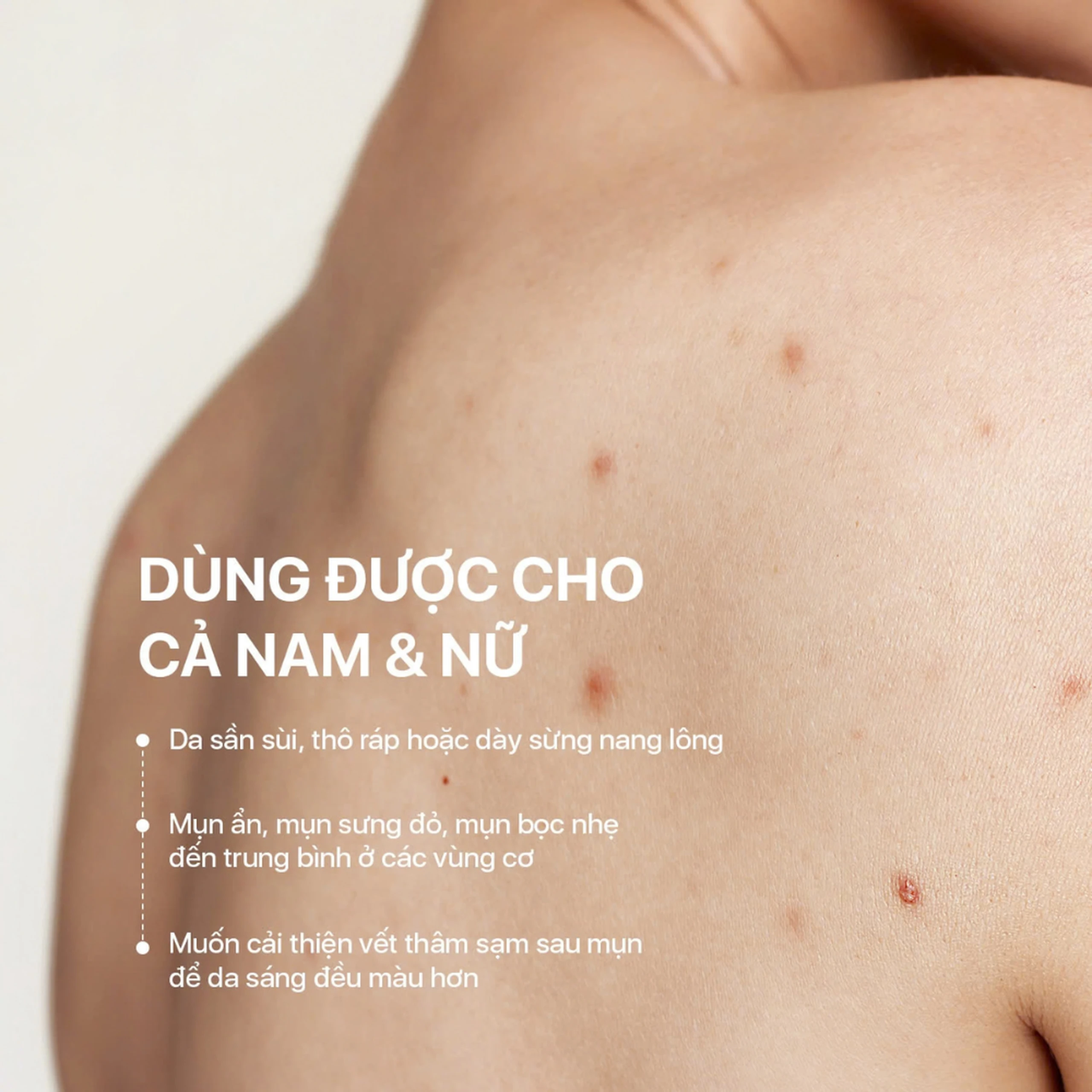 Xịt giảm mụn lưng Neo Acnes làm dịu nốt mụn, giảm tình trạng mụn trên da cơ thể (100ml) 3