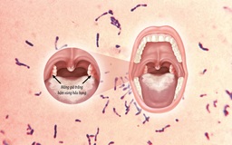 vi khuẩn Corynebacterium diphtheriae, nguyên nhân chính gây bệnh bạch hầu