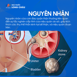 Nguyên nhân đau quặn thận - Sỏi thận và các yếu tố gây cơn đau quặn thận