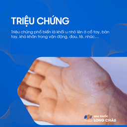 Bướu Hoạt Dịch Cổ Tay 2