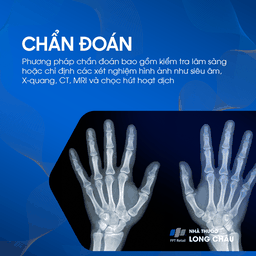 Bướu Hoạt Dịch Cổ Tay 5