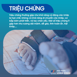 Cứng Đa Khớp Bẩm Sinh 2