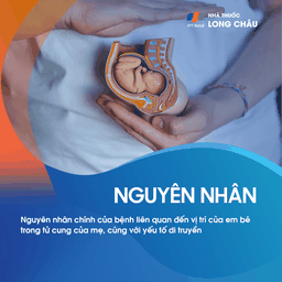 Xoắn Xương Đùi 3