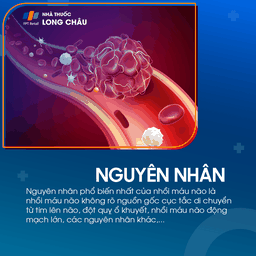 Nguyên nhân gây bệnh nhồi máu não chủ yếu do tắc nghẽn mạch máu trong nã