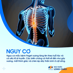 Paget xương 4