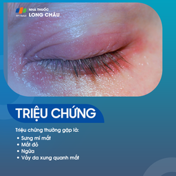  Viêm bờ trên mi mắt là gì? Nguyên nhân, triệu chứng và cách điều trị 2