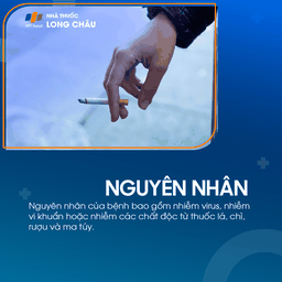 Viêm dây thần kinh tiền đình 3