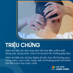 Triệu chứng viêm da do tiếp xúc với da đỏ, ngứa và phát ban