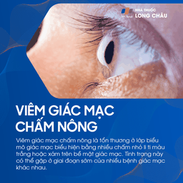 Viêm giác mạc chấm nông 1