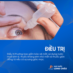 Viêm giác mạc chấm nông 6