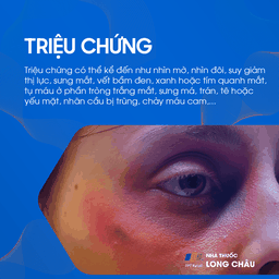 Vỡ xương hốc mắt 1