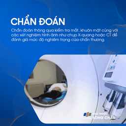 Vỡ xương hốc mắt 5
