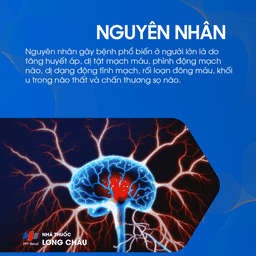 Xuất huyết não thất 4