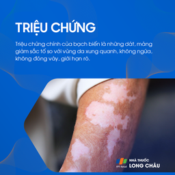 Triệu chứng bạch biến là các dát giảm sắc tố rõ ràng, không ngứa, không đóng vảy