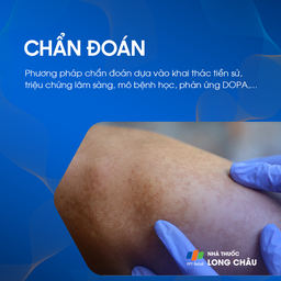 Chẩn đoán bạch biến dựa trên tiền sử, triệu chứng lâm sàng và các xét nghiệm chuyên sâu