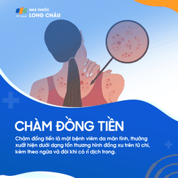 Chàm đồng tiền hay còn được gọi là chàm dạng đĩa hoặc viêm da đồng tiền