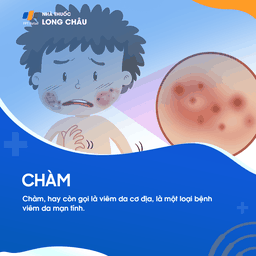 Chàm (viêm da cơ địa) là bệnh viêm da mạn tính, thường gây ngứa