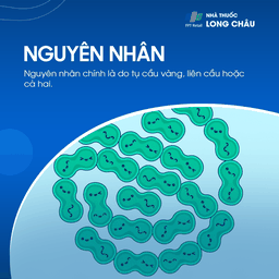 Do vi khuẩn tụ cầu vàng, liên cầu, hoặc cả hai gây ra