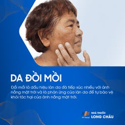 đồi mồi, tình trạng tăng sắc tố da xuất hiện dưới dạng các vết sậm màu trên da