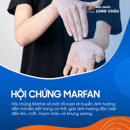 Hội chứng Marfan 1