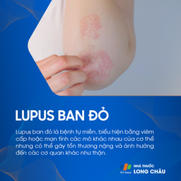 Tổn thương lupus ban đỏ trên vùng da tay – bệnh tự miễn gây viêm mô