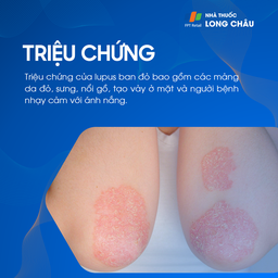 Hình ảnh mảng da đỏ, tróc vảy ở khuỷu tay – triệu chứng lupus ban đỏ