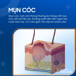 Mụn cóc thường trên ngón tay – tổn thương da sần sùi do virus HPV