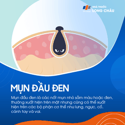 Mụn Đầu Đen 1