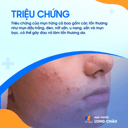 Mụn trứng cá 2