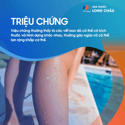 Triệu chứng nổi mề đay với những mảng phát ban đỏ trên da