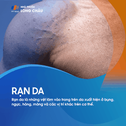 Rạn da (đường vân) là những vệt lõm vào trong xuất hiện trên bụng, ngực, hông, mông