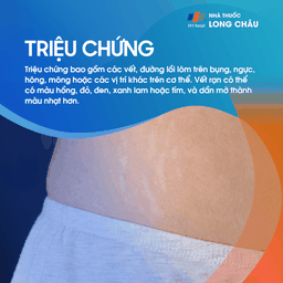 các vết rạn da đỏ hồng và trắng trên da bụng, điển hình ở phụ nữ mang thai