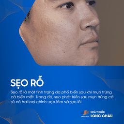 Sẹo rỗ trên mặt là hậu quả của mụn trứng cá, biểu hiện rõ ràng qua các lỗ nhỏ trên da