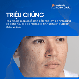 Triệu chứng của sẹo rỗ là các lỗ nhỏ sâu trên da, thường xuất hiện sau mụn trứng cá hoặc thủy đậu