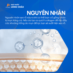 Nguyên nhân chính gây sẹo rỗ là do tổn thương tầng sâu của da, thường liên quan đến việc điều trị mụn không đúng cách