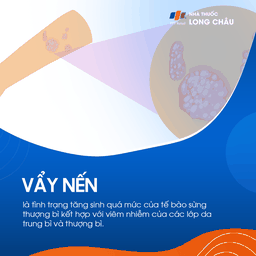 Vảy nến là tình trạng tăng sinh quá mức tế bào sừng kết hợp viêm da ở lớp thượng bì và trung bì