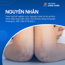 Nguyên nhân vảy nến liên quan đến phản ứng miễn dịch quá mức của tế bào T trong lớp thượng bì