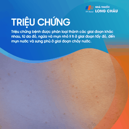 Triệu chứng viêm da cơ địa qua các giai đoạn phát ban và chảy nước