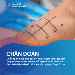 Viêm Da Dị Ứng 6
