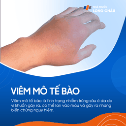 Viêm Mô Tế Bào 1