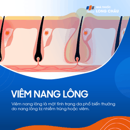 Viêm nang lông là một tình trạng da phổ biến thường do nang lông bị nhiễm trùng 