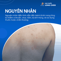 Nguyên nhân gây viêm nang lông như nhiễm khuẩn, cạo lông