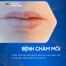 Chàm môi là gì? Nguyên nhân gây bệnh và nguyên tắc phòng ngừa