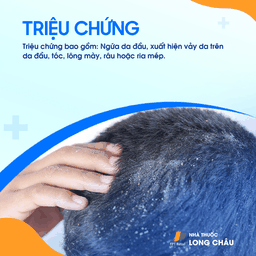 Vảy trắng và ngứa da đầu là triệu chứng phổ biến của gầu